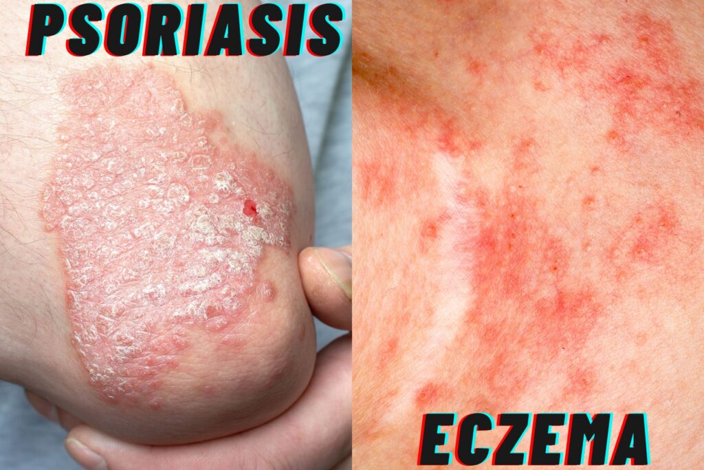Image/visual comparison between Eczema and Psoriais patches. 