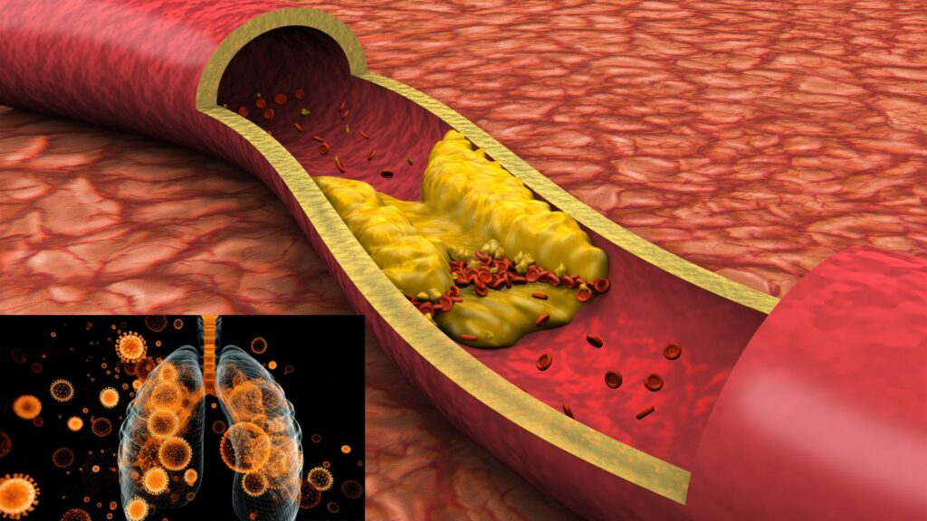 diagram of coronary artery disease showing plaque build-up, natural heart health prevention guide UK 2026